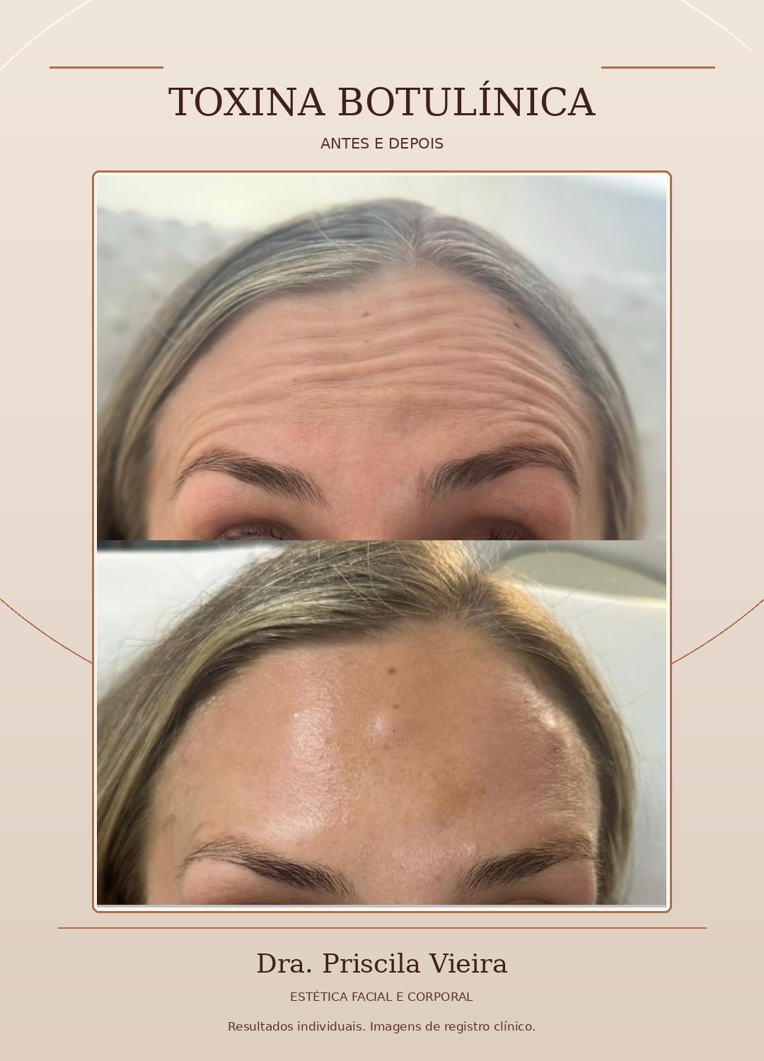 Comparativo fotográfico de linhas da testa, antes e depois